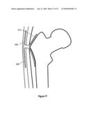 HIP PROTECTOR IMPLANT diagram and image