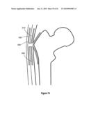 HIP PROTECTOR IMPLANT diagram and image