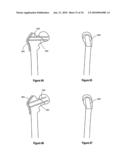 HIP PROTECTOR IMPLANT diagram and image