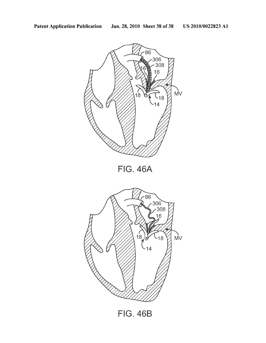 METHODS AND DEVICES FOR TISSUE GRASPING AND ASSESSMENT - diagram, schematic, and image 39