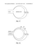 VENTRICULAR SHUNT SYSTEM AND METHOD diagram and image