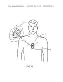 CPR ASSIST DEVICE FOR MEASURING COMPRESSION VARIABLES DURING CARDIOPULMONARY RESUSCITATION diagram and image