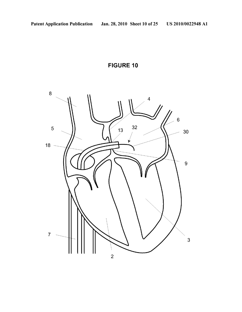 Steerable Catheter and Dilator and System and Method for Implanting a Heart Implant - diagram, schematic, and image 11