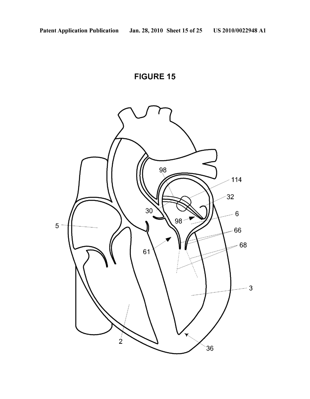 Steerable Catheter and Dilator and System and Method for Implanting a Heart Implant - diagram, schematic, and image 16