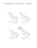 RF intervertebral disc surgical system diagram and image