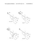 RF intervertebral disc surgical system diagram and image