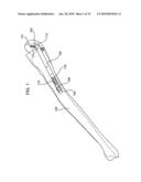 FRACTURE FIXATION DEVICE, TOOLS AND METHODS diagram and image