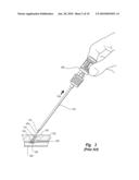 TISSUE PUNCTURE CLOSURE METHOD WITH DISENGAGABLE AUTOMATIC TAMPING SYSTEM diagram and image