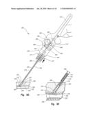 TISSUE PUNCTURE CLOSURE METHOD WITH DISENGAGABLE AUTOMATIC TAMPING SYSTEM diagram and image