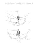 TETHER-ANCHOR ASSEMBLIES diagram and image