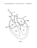 TETHER-ANCHOR ASSEMBLIES diagram and image