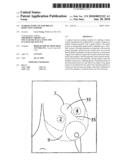 Marker Template for Breast Reduction Surgery diagram and image