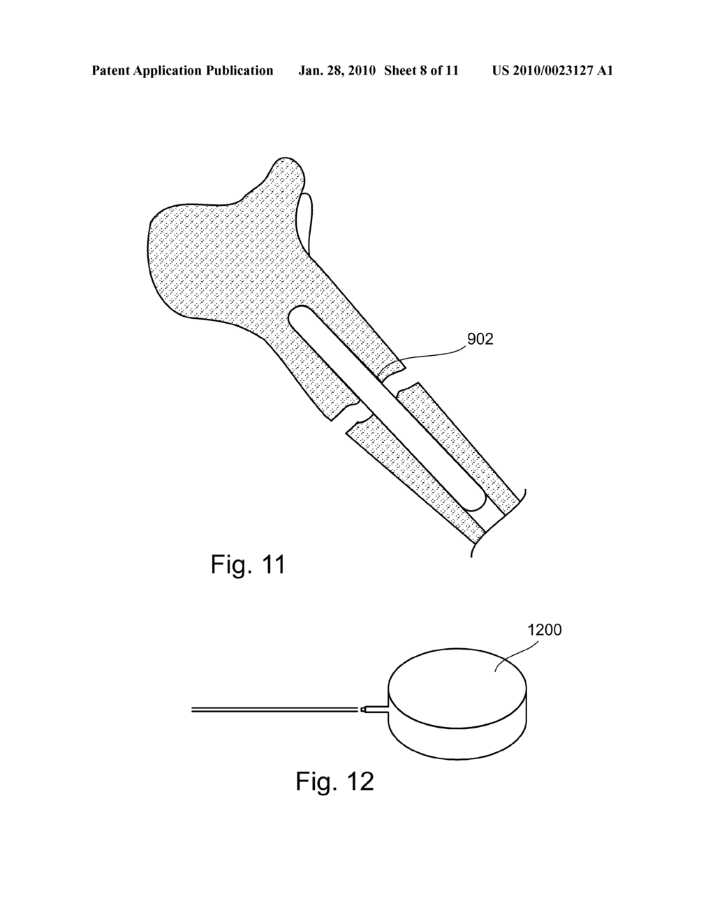 PROSTHETIC DEVICES AND METHODS FOR USING SAME - diagram, schematic, and image 09
