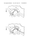 METHODS AND DEVICES FOR FORMING AN AUXILIARY AIRWAY FOR TREATING OBSTRUCTIVE SLEEP APNEA diagram and image