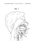 METHODS AND DEVICES FOR FORMING AN AUXILIARY AIRWAY FOR TREATING OBSTRUCTIVE SLEEP APNEA diagram and image