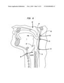 METHODS AND DEVICES FOR FORMING AN AUXILIARY AIRWAY FOR TREATING OBSTRUCTIVE SLEEP APNEA diagram and image