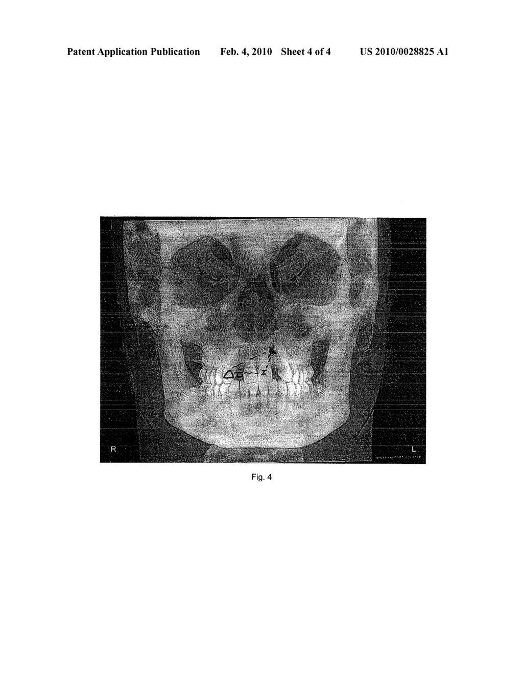 Method and System of Determining and Applying Orthodontic Forces Dependent on Bone Density Measurements - diagram, schematic, and image 05