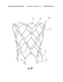 BARIATRIC DEVICE AND METHOD diagram and image