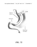 BARIATRIC DEVICE AND METHOD diagram and image