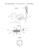 ENDOSCOPIC SURGICAL OPERATION METHOD diagram and image
