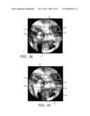 Paranasal Ostium Finder Devices and Methods diagram and image