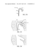 Paranasal Ostium Finder Devices and Methods diagram and image