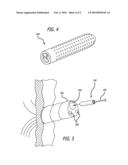 PERMANENT UMBILICAL HOLLOW TUBE diagram and image