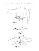 APPARATUS FOR GUIDING THE PLACEMENT OF A SUBCUTANEOUS DEVICE diagram and image