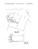 APPARATUS FOR GUIDING THE PLACEMENT OF A SUBCUTANEOUS DEVICE diagram and image