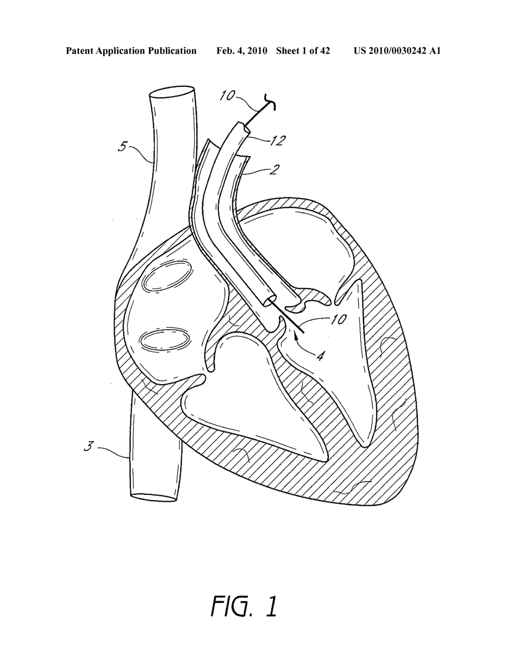 SUTURING DEVICES AND METHODS FOR SUTURING AN ANATOMIC VALVE - diagram, schematic, and image 02