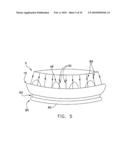 Fixation band for affixing a prosthetic heart valve to tissue diagram and image