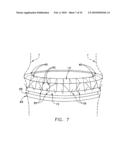 Fixation band for affixing a prosthetic heart valve to tissue diagram and image