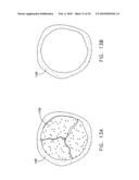 Fixation band for affixing a prosthetic heart valve to tissue diagram and image