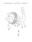 Fixation band for affixing a prosthetic heart valve to tissue diagram and image