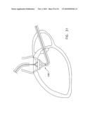 Fixation band for affixing a prosthetic heart valve to tissue diagram and image