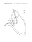 Fixation band for affixing a prosthetic heart valve to tissue diagram and image