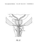 ANCHOR DELIVERY SYSTEM WITH REPLACEABLE CARTRIDGE diagram and image