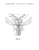 ANCHOR DELIVERY SYSTEM WITH REPLACEABLE CARTRIDGE diagram and image