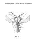 ANCHOR DELIVERY SYSTEM WITH REPLACEABLE CARTRIDGE diagram and image