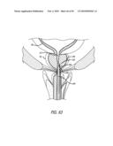 ANCHOR DELIVERY SYSTEM WITH REPLACEABLE CARTRIDGE diagram and image