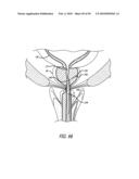 ANCHOR DELIVERY SYSTEM WITH REPLACEABLE CARTRIDGE diagram and image