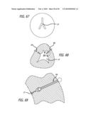 ANCHOR DELIVERY SYSTEM WITH REPLACEABLE CARTRIDGE diagram and image