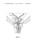 SLOTTED ANCHOR DEVICE diagram and image