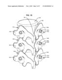 SURGICAL TOOL AND METHOD FOR IMPLANTATION OF A DYNAMIC BONE ANCHOR diagram and image