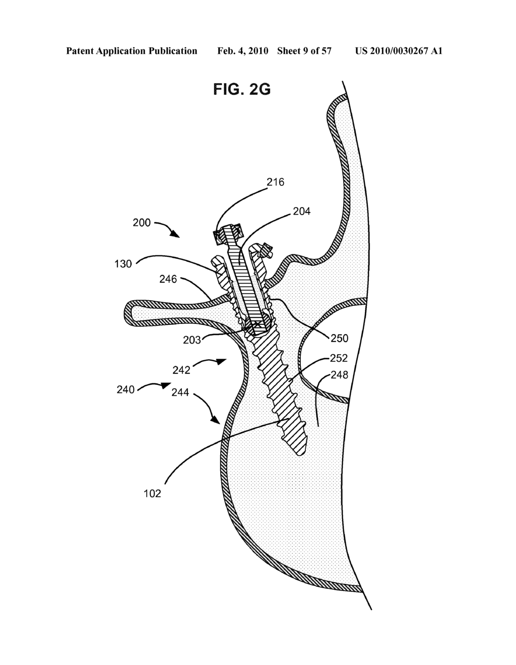 SURGICAL TOOL AND METHOD FOR IMPLANTATION OF A DYNAMIC BONE ANCHOR - diagram, schematic, and image 10