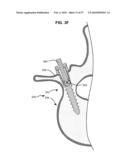 SURGICAL TOOL AND METHOD FOR IMPLANTATION OF A DYNAMIC BONE ANCHOR diagram and image