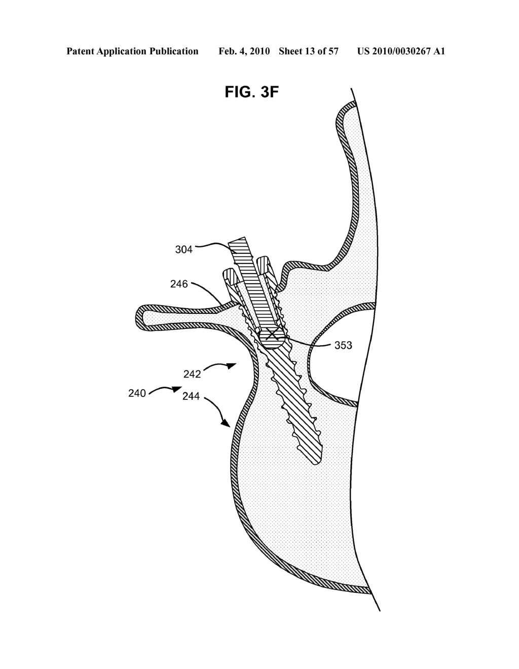 SURGICAL TOOL AND METHOD FOR IMPLANTATION OF A DYNAMIC BONE ANCHOR - diagram, schematic, and image 14