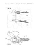 SURGICAL TOOL AND METHOD FOR IMPLANTATION OF A DYNAMIC BONE ANCHOR diagram and image