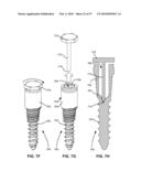 SURGICAL TOOL AND METHOD FOR IMPLANTATION OF A DYNAMIC BONE ANCHOR diagram and image