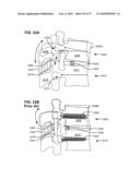 SURGICAL TOOL AND METHOD FOR IMPLANTATION OF A DYNAMIC BONE ANCHOR diagram and image